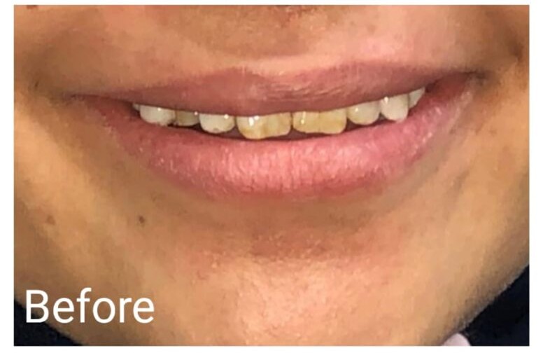 Before treatment image