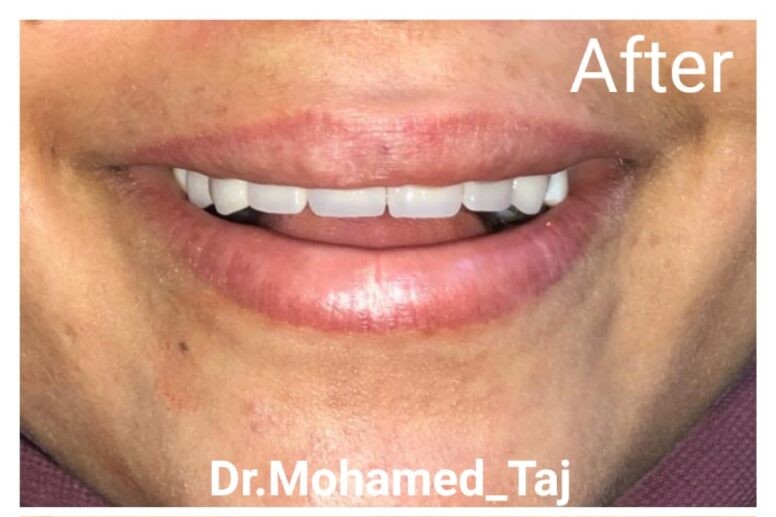 After treatment image